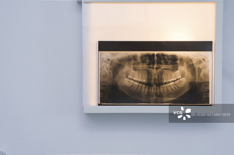 分析牙科X光片：墙上观察器中的牙齿X光片图片素材