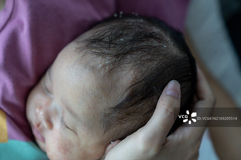 婴儿脂溢性皮炎或摇篮帽图片素材