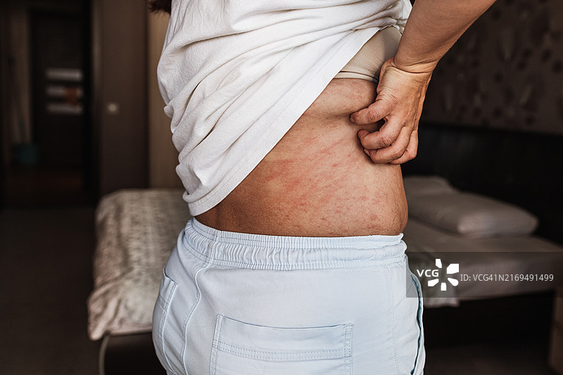 女子掀起衬衫挠背，背部有红色皮疹图片素材