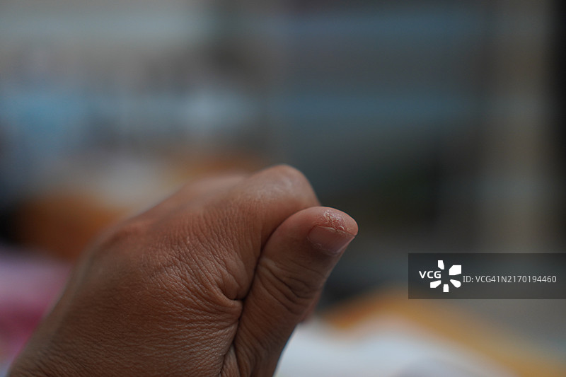 拇指上的刀伤图片素材