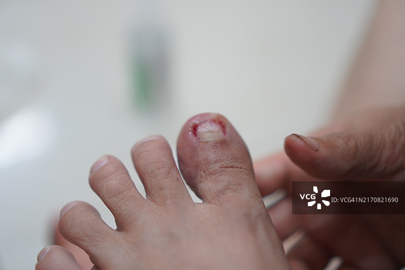 真菌感染引起的拇指出血图片素材