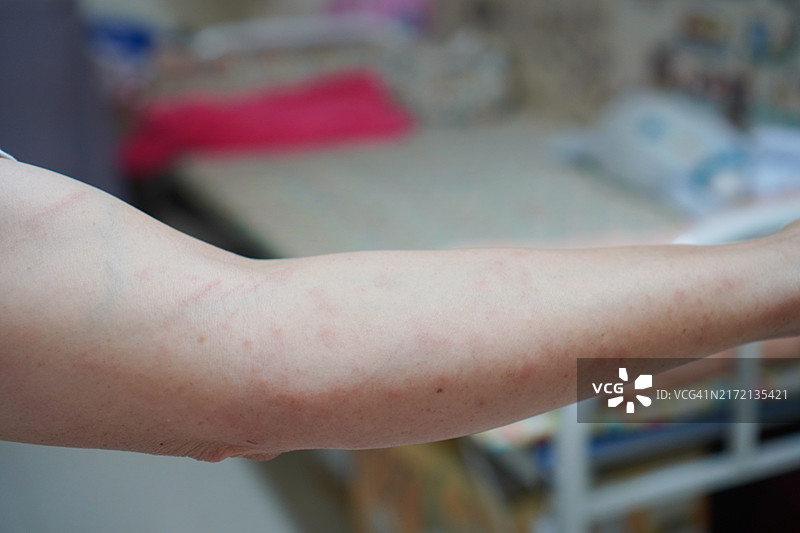 手臂上的红色皮疹图片素材