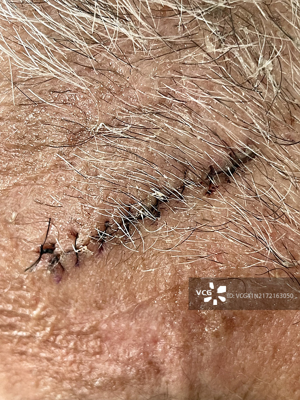 术后缝合伤口特写图片素材