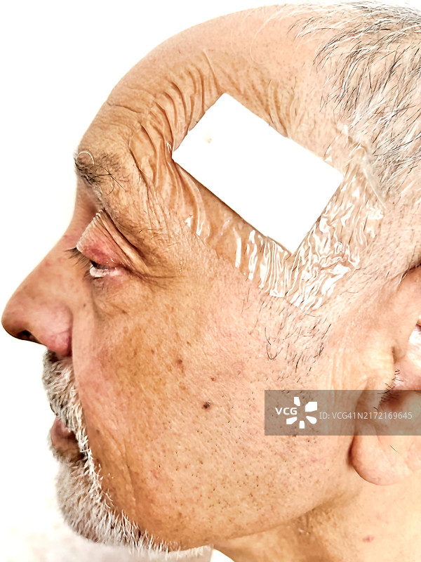 头部手术石膏图片素材