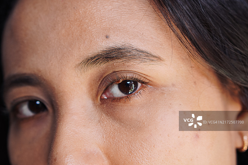 女人眼部的疣图片素材