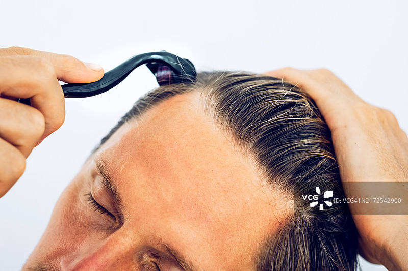 男人使用微针滚轮护理发际线，用于头皮护理和毛囊刺激特写图片素材