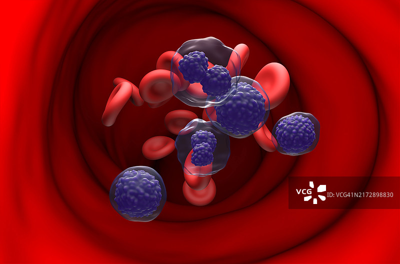 浆细胞白血病，图示图片素材