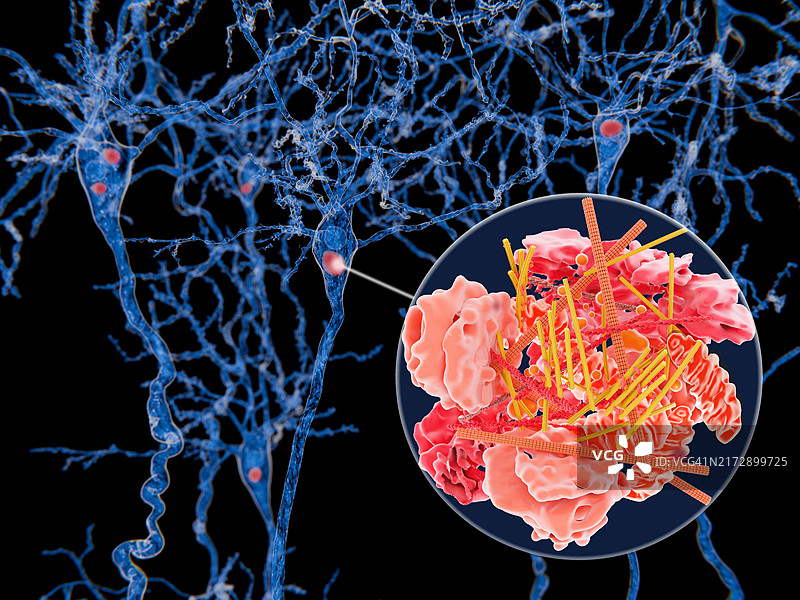 神经细胞中的路易体，图示图片素材