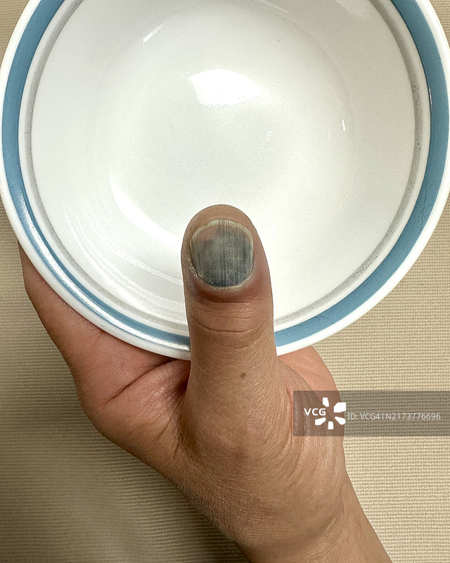 坏死的拇指甲图片素材