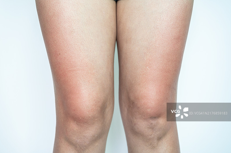 女性大腿晒伤的特写镜头，长时间暴露在阳光下导致皮肤发红、疼痛和受损图片素材