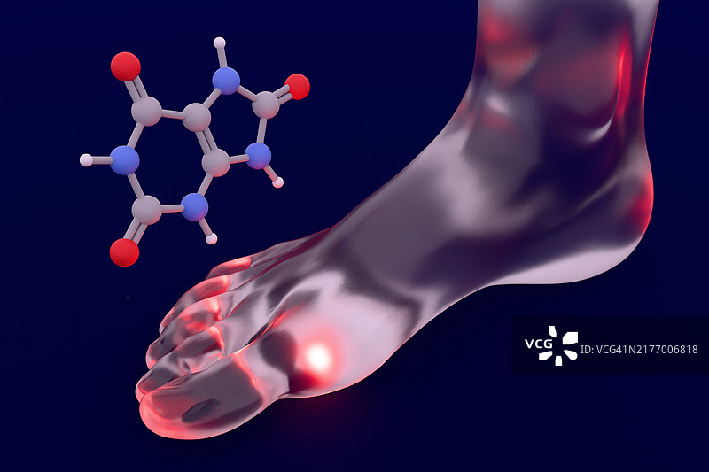 腿部痛风疼痛与尿酸结构图片素材