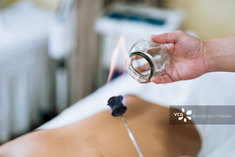 拔罐疗法：一位年轻的中医医生准备玻璃罐，用火焰为一位年轻的亚洲运动员进行拔罐治疗。传统中医系列图片素材