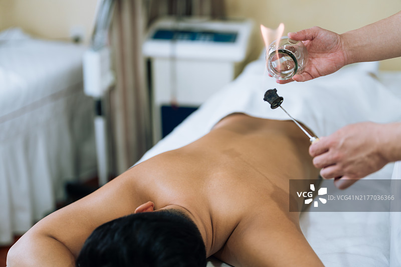 拔罐治疗：一位年轻的中国医生准备用火焰加热玻璃罐，为一位年轻的亚洲运动员进行拔罐。传统中医系列。图片素材