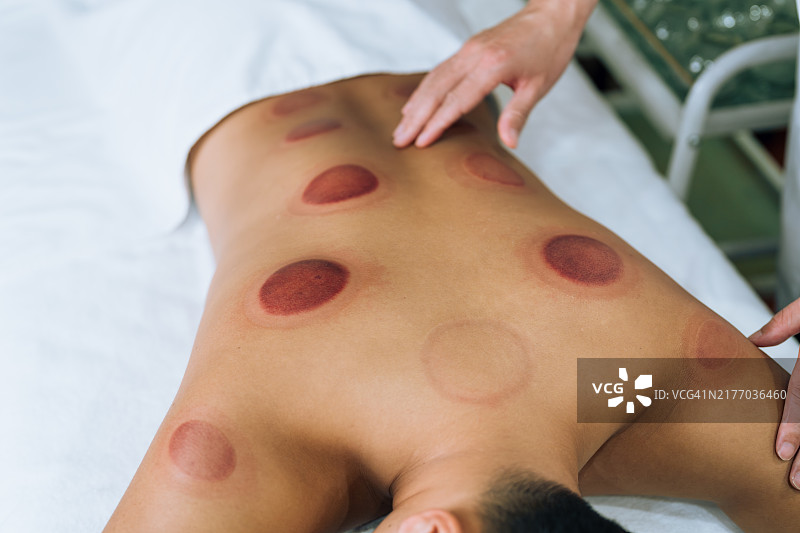 拔罐治疗：年轻男运动员背部的红色罐印，传统中医系列图片素材