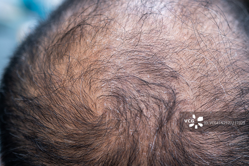 亚洲男人头顶稀疏白发的特写镜头图片素材