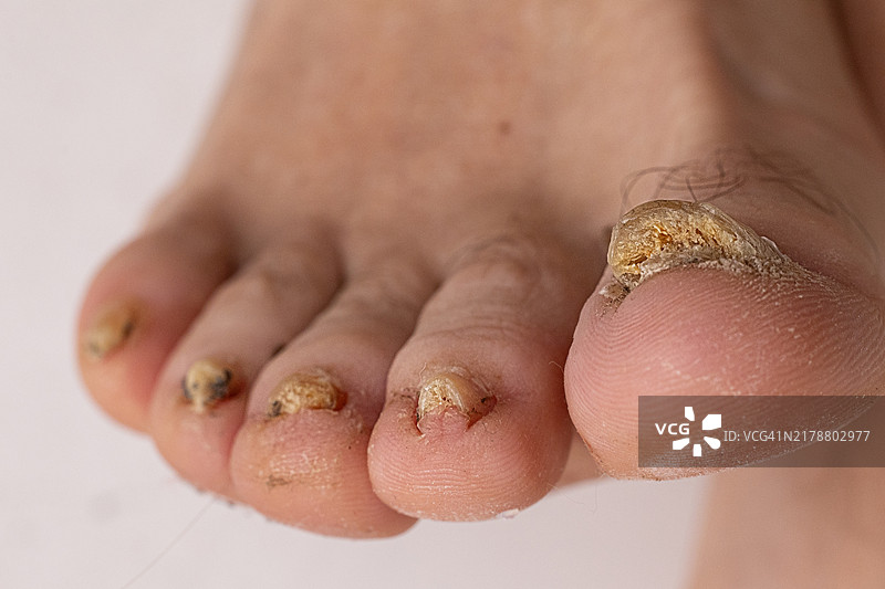 识别脚趾甲真菌：视觉症状和特征图片素材
