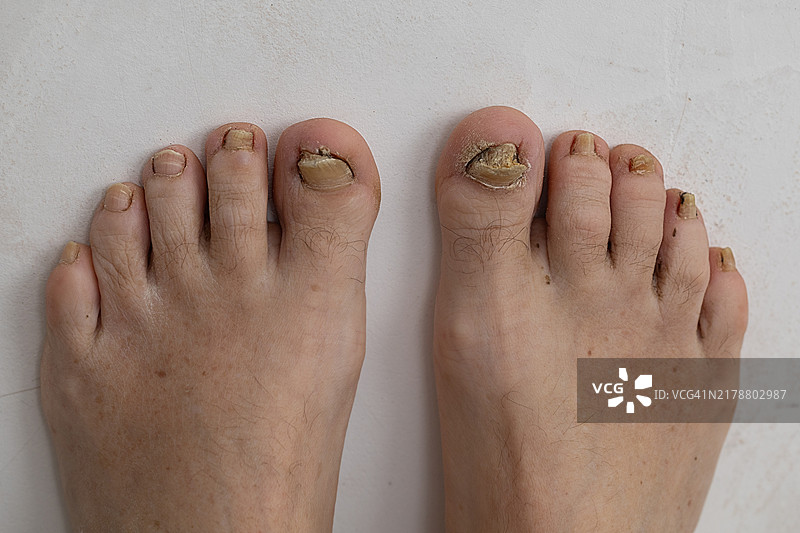 成年女性患有真菌感染的脚部俯视图：指甲增厚卷曲且脏污图片素材