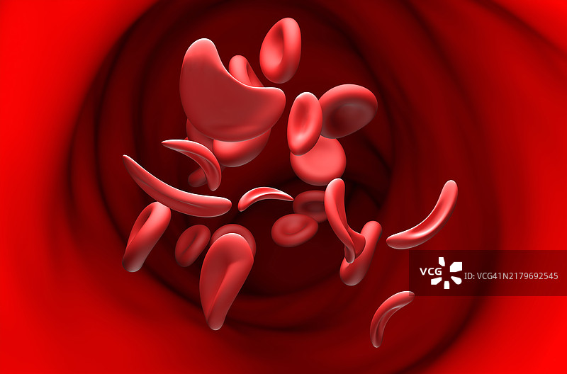 镰状细胞贫血症插图图片素材