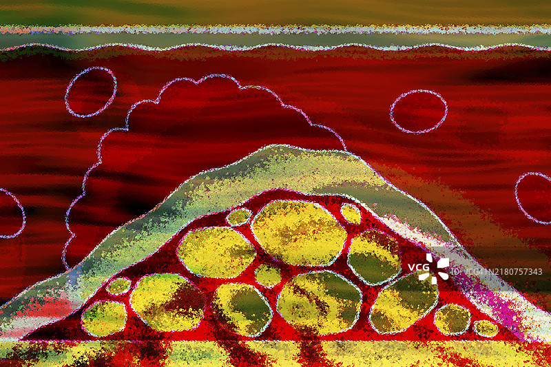 动脉硬化是一种常见的血管疾病，动脉因脂肪等沉积物而变窄变硬图片素材