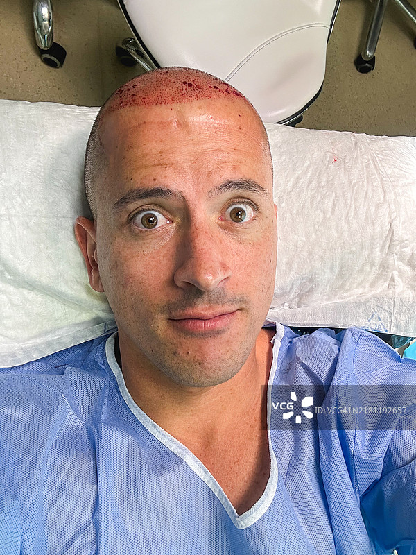 床上自拍的男子正在进行植发手术图片素材