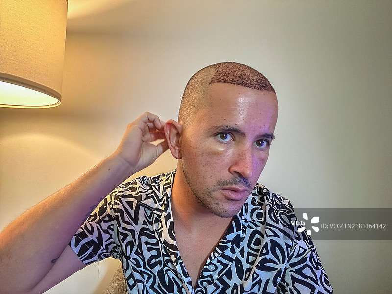 男子在植发后照顾自己的头部图片素材