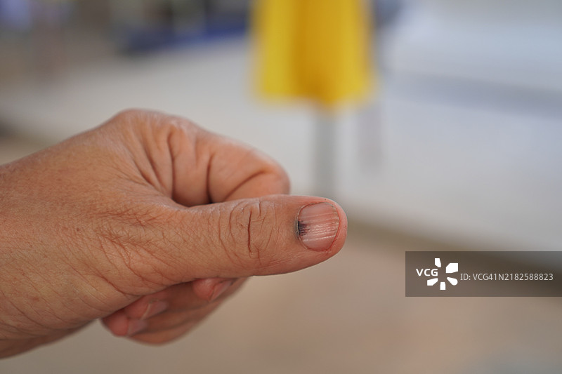 甲下血肿图片素材