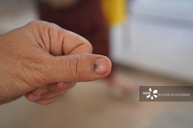 甲下血肿图片素材