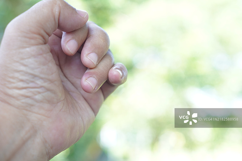 嵌甲症图片素材