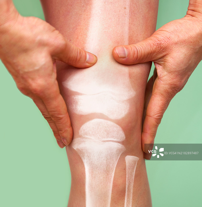 膝关节X光 - 骨关节炎和类风湿性关节炎图片素材