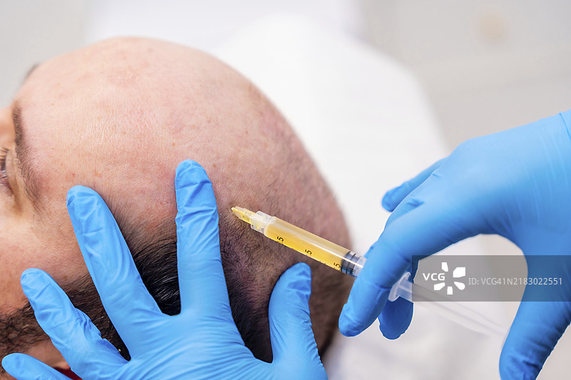 医疗人员的手部特写，正在使用血浆注射治疗脱发。图片素材