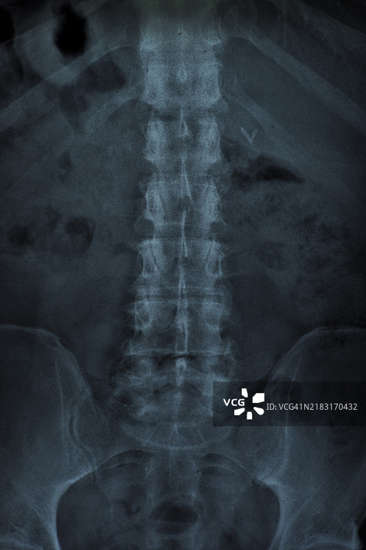 脊柱X光检查图片素材
