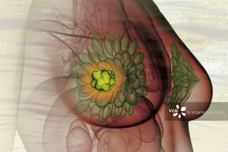 女性乳腺癌的插图，乳腺癌是女性中最常见的癌症。图片素材