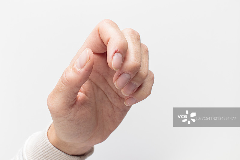 变形指甲的手特写，撕裂和剥落的指甲周围皮肤。图片素材