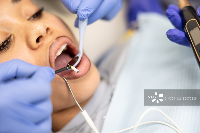 年轻非裔美国女性的嘴部特写，牙医正在为她进行根管填充治疗。图片素材