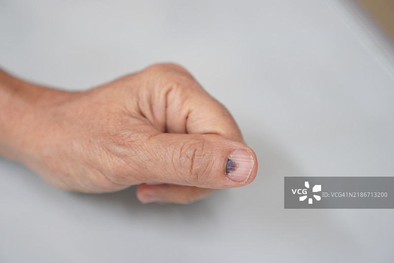 血肿，出血，拇指图片素材