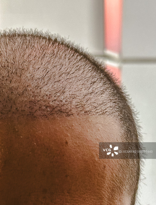 男性在植发三周后的头皮图片素材