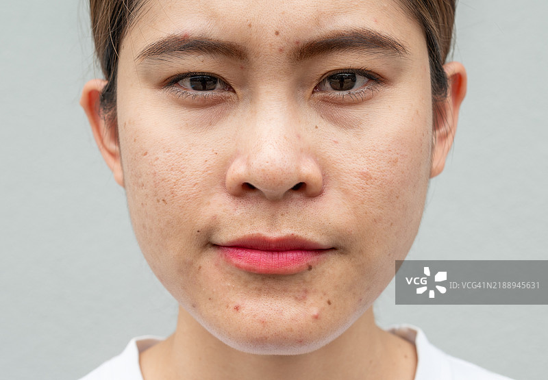 面容不悦的亚洲女性，皮肤上有痘痘、皱纹和雀斑，显示出衰老的迹象。图片素材