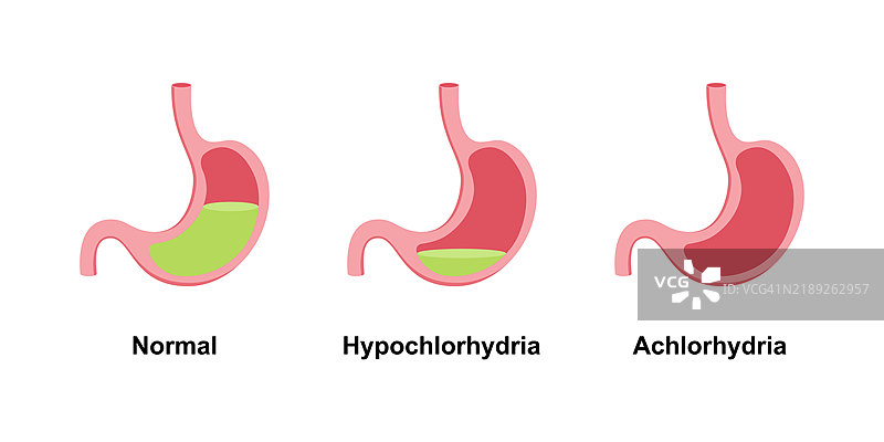 无盐酸症插图图片素材