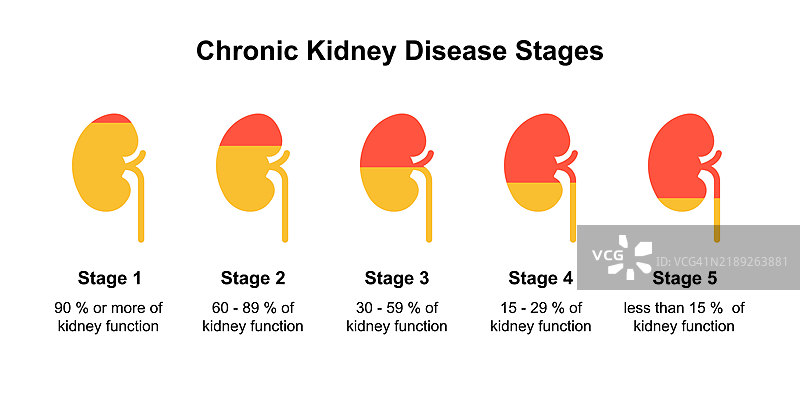 慢性肾病分期插图图片素材
