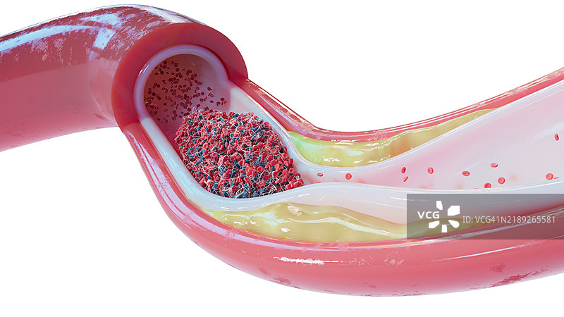 人类血管中的动脉粥样硬化和血栓插图图片素材