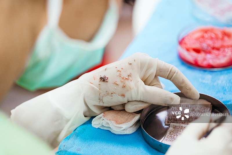 植发，医生在植发手术前仔细分离提取的毛囊。图片素材