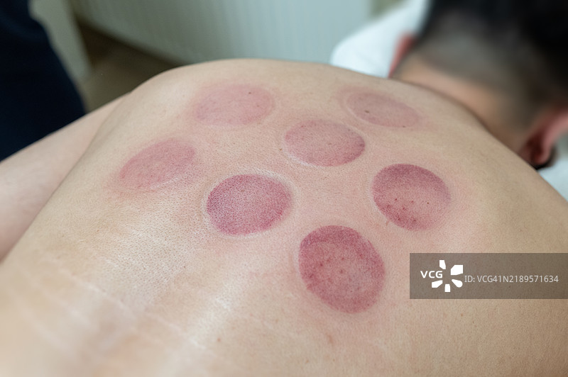 患者在背部接受拔罐疗法以缓解疼痛图片素材