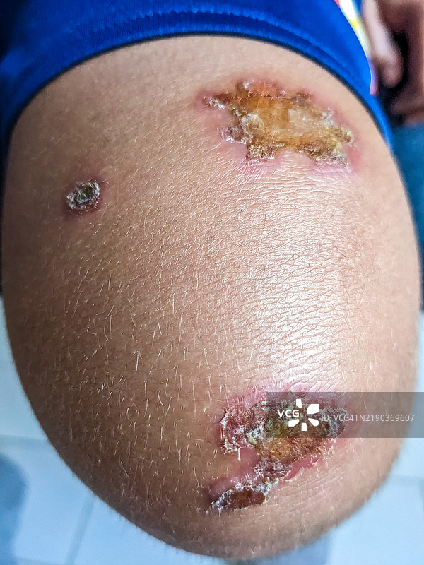 儿童膝盖上的脓疱性皮肤病图片素材