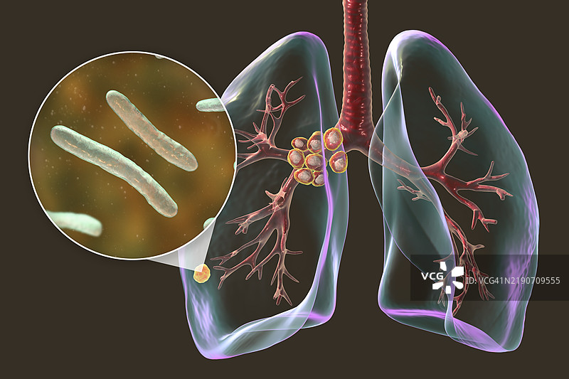 初级肺结核伴Ranke复合体插图图片素材