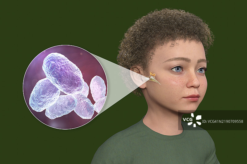 儿童中耳炎插图图片素材