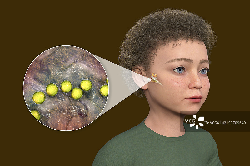 儿童中耳炎插图图片素材