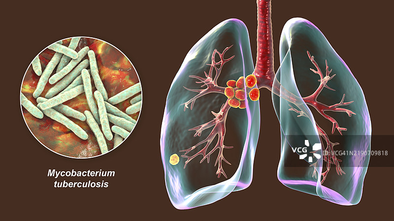 初级肺结核插图图片素材