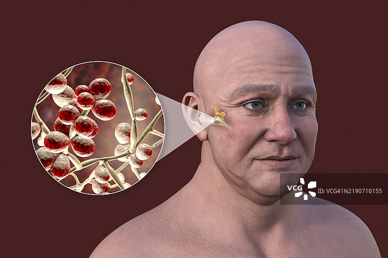 男性中耳炎插图图片素材