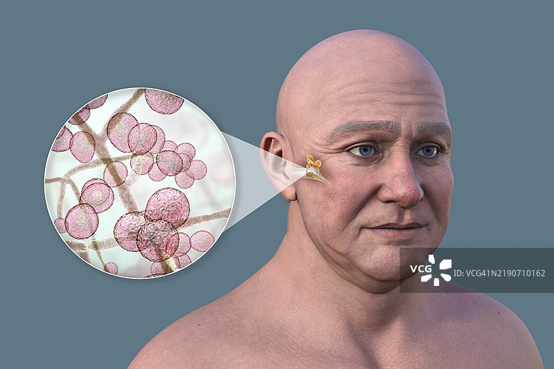 男性中耳炎插图图片素材