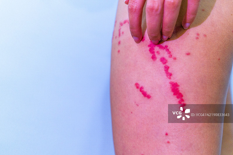 人类皮肤上红色皮疹的特写，显示出炎症和过敏或皮肤病症状。图片素材